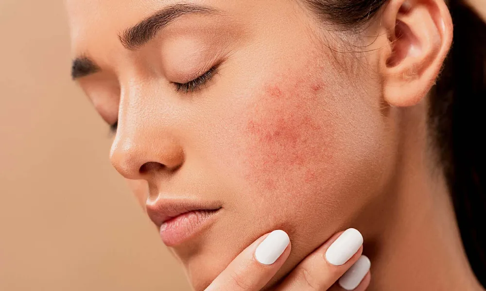 جلوگیری از لک صورت | لک قرمز رنگی روی پوست گونه ی یک خانم